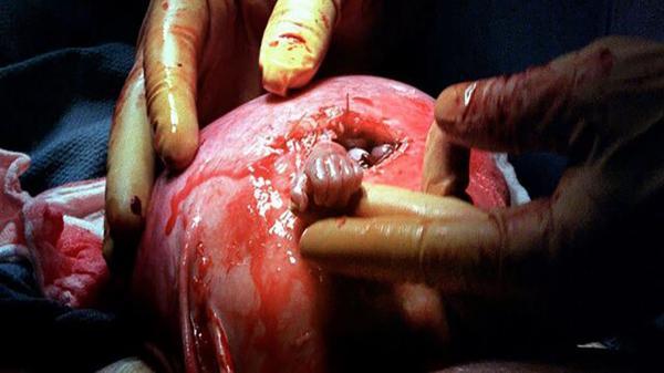 عکس جنینی که پیش از تولد دست جراحش را فشرد