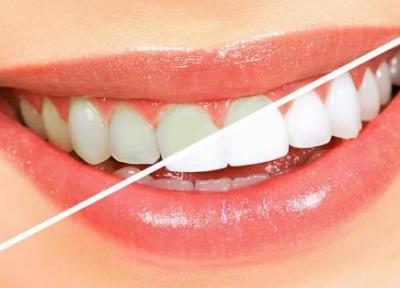 5 روش ساده و طبیعی سفید کردن دندان ها